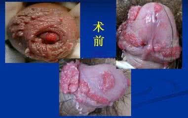 尖锐湿疹有息肉状 此句尖锐，句句到肉