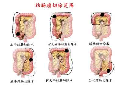 结肠癌的症状及治疗 结肠癌的症状及治疗 轻松治疗结肠癌
