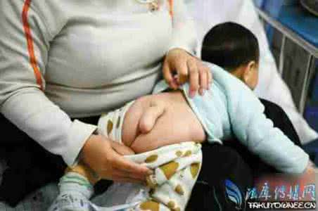 胎儿泌尿系统畸形 那些影响孕妇生孩子畸形的事儿