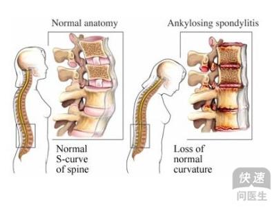 中医治疗强直性脊柱炎 中医强直性脊柱炎治疗 中医治疗强直 治疗强直性脊柱炎的方法