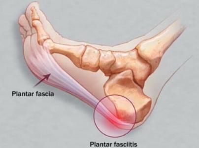 足跟骨刺偏方治疗方法 足跟骨刺 治疗足跟骨刺有偏方