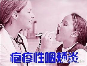 爸爸妈妈 爸爸千万不要 江浙地区爸爸妈妈注意,疱疹性咽峡炎千万别当感冒
