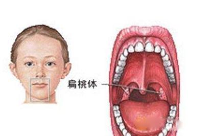 如何快速让扁桃体发炎 让扁桃体一生不发炎的妙方