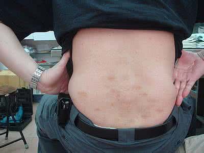 男人阴囊潮湿的原因 阴囊潮湿怎么回事 阴囊潮湿的几种原因