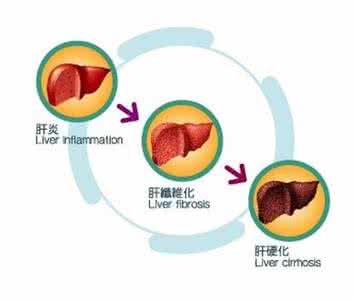 尿液传染乙肝吗 尿液和粪便传染乙肝吗 胎宝宝尿液粪便都去哪儿了?