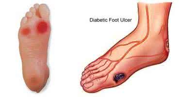 糖尿病足的护理措施 糖尿病足的护理 糖尿病足的护理措施
