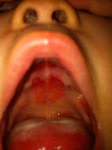 艾滋病 口腔溃疡 艾滋病 口腔溃疡 别拿“口腔溃疡”不当病