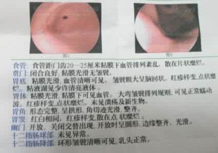 浅表性胃炎的治疗方法 浅表性胃炎怎么治疗 治疗浅表性胃炎的方法