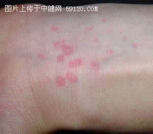 艾滋病红色斑丘疹图片 艾滋病红色斑丘疹图片 艾滋病初期症状丘疹 患上艾滋的早期现象