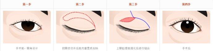 上睑松弛整形术 上睑松弛整形术 四种颈部整形术