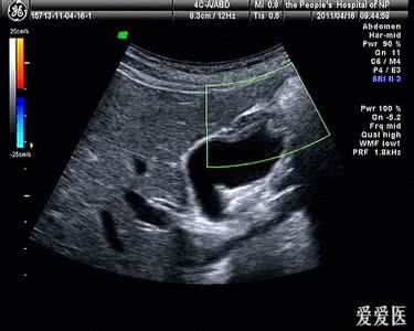 胆囊腺肌症的注意事项 胆囊腺肌症 三大胆囊腺肌症的类型