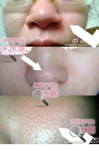激光治疗毛孔粗大价格 女生毛孔粗大怎么办