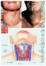 甲亢开刀治疗费用 家传秘方：不必开刀的甲亢圣方