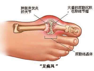 痛风治疗方法 痛风快速治疗方法 痛风怎么办快速止痛 痛风的治疗方法