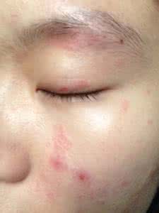 皮肤过敏变黑 紫外线皮肤过敏 皮肤变黑一定是紫外线的过?