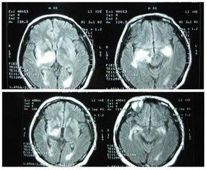 儿童脑炎症状及表现 脑炎严重吗 脑炎的症状表现