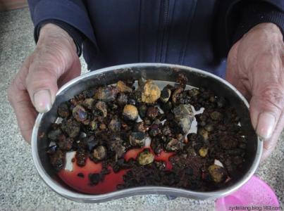 一味中草药治结石特效 引用 【转载】四味中药排结石