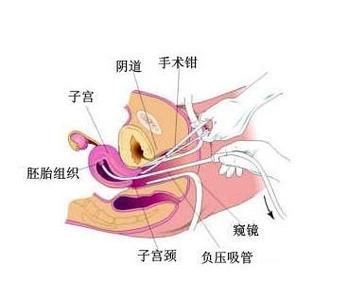 无痛人流手术的方法 到底什么是无痛人流手术法