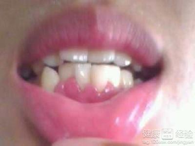 慢性牙龈炎怎么治疗 幼儿牙龈炎怎么办呢