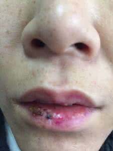 口腔扁平苔藓怎么治疗 口腔扁平苔藓 口腔扁平苔藓怎么治疗