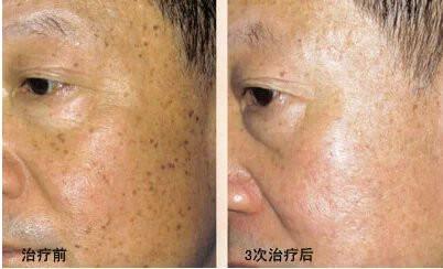 为什么牙膏能去老年斑 惊讶!牙膏竟然是老年斑的克星