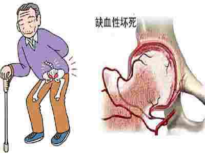 冲击波治疗股骨头坏死 股骨头坏死的中要调理 股骨头坏死的冲击调理