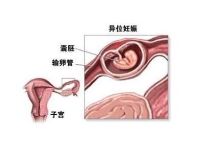 宫外孕早期症状治疗 宫外孕是怎么引起的 宫外孕的症状与治疗