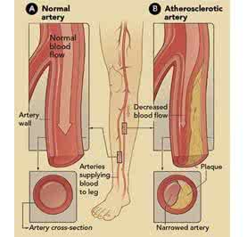 动脉硬化闭塞症治疗 冠脉闭塞是什么意思 中医如何治动脉硬化