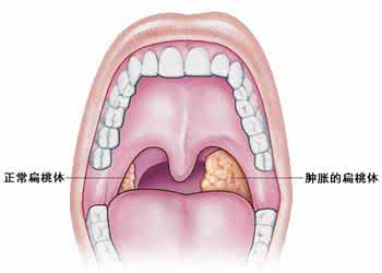 扁桃体肥大偏方点盐水 扁桃体偏方大全11篇