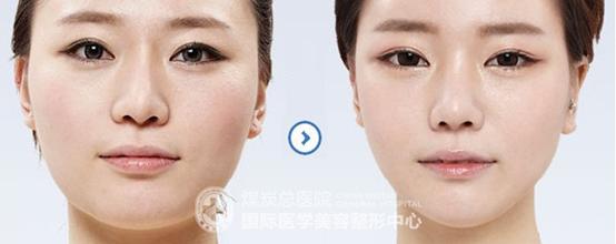 面部吸脂后护理 面部吸脂修复 面部吸脂恢复如何护理？