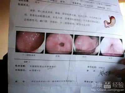 重度萎缩性胃炎症状 萎缩性胃炎的症状 如何防治萎缩性胃炎