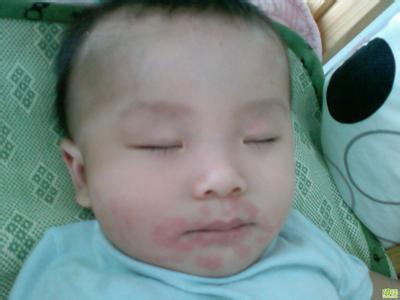 皮肤过敏都有什么症状 皮肤过敏都什么症状 过敏反应的症状有哪些