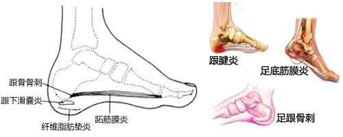 脚后跟疼痛的原因 脚后跟疼痛 脚后跟疼的几种病因