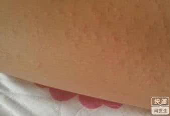 孕妇得风疹病毒怎么办 孕妇风疹怎么办