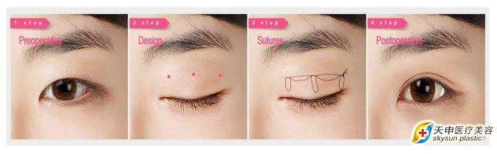 双眼皮手术埋线法 双眼皮手术埋线法 埋线法双眼皮手术介绍