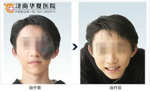 治疗太田痣样斑的方法 治疗太田痣样斑的方法 专业治疗太田痣样斑