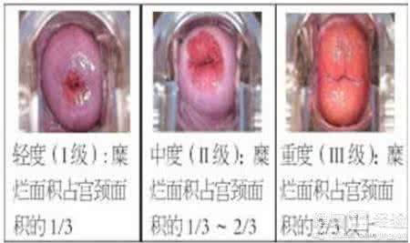 慢性子宫颈炎症的症状 慢性宫颈炎症的症状有哪些?
