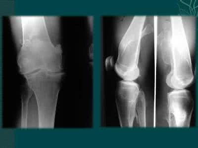 良性骨肿瘤有哪些 骨肿瘤 骨肿瘤的治疗方法有哪些