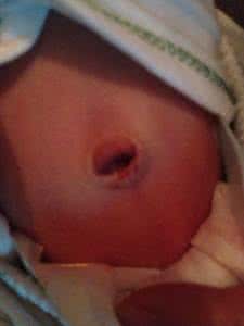 肚脐眼发炎流脓怎么办 肚脐眼发炎流脓怎么办 孩子肚脐眼发炎的预防