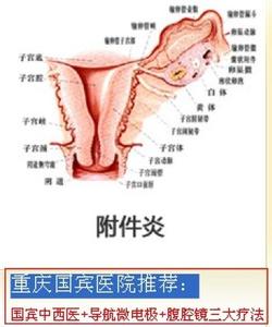 治疗附件炎的偏方大全 慢性附件炎怎样诊断 附件炎的偏方