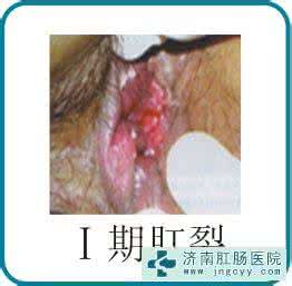 简单快捷治肛裂偏方 肛裂怎么治