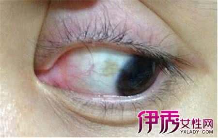 黄斑病变治疗方法 黄斑病变治疗 黄斑病变治疗 教大家如何治疗黄斑病变