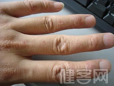 手足癣最佳治疗方法 手足癣最佳治疗方法 治疗手癣的最佳方法