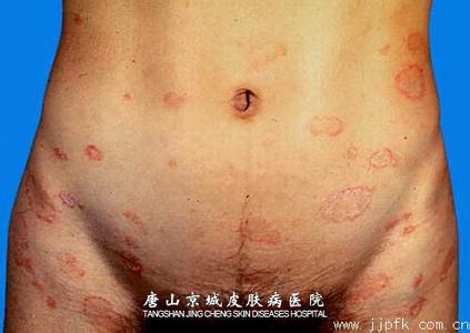 玫瑰糠疹早期症状 玫瑰糠疹后期症状 早知道早防御