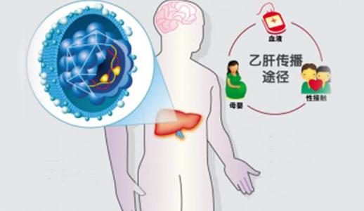 慢性乙肝防治指南 防治乙肝六个要点