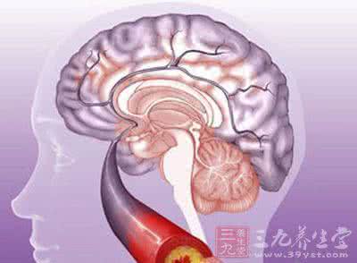 治疗脑血栓什么药最好 脑血栓吃什么好 吃这些可以治疗脑血栓