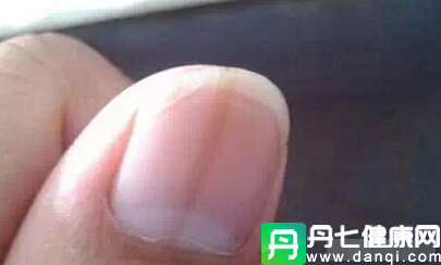 灰指甲的初期症状 指甲这种症状看你是否能活五十