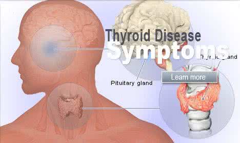 亚急性甲状腺炎症状 慢性淋巴细胞性甲状腺炎 它的症状有哪些