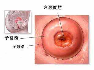 宫颈炎症状表现 宫颈炎症状表现 宫颈炎症状