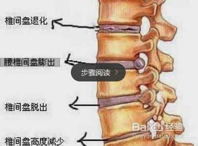 治疗腰椎间盘突出偏方 我是这样治疗腰椎间盘突出的